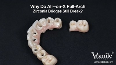 Why Do All-on-X Full-Arch Bridges Still Break? A Practical Guide for Clinics ...